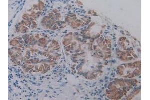 IHC-P analysis of Human Lung Cancer Tissue, with DAB staining. (AKT2 抗体  (AA 142-412))