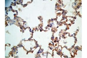 Rat lung cancer tissue stained by Rabbit Anti-CRAMP (Mouse) Antibody (Cathelicidin 抗体  (AA 140-173))