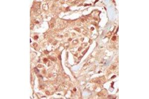 Formalin-fixed and paraffin-embedded human cancer tissue reacted with the primary antibody, which was peroxidase-conjugated to the secondary antibody, followed by DAB staining. (CDK18 抗体  (N-Term))