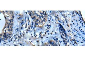 Immunohistochemistry of paraffin-embedded Human cervical cancer tissue using UFC1 Polyclonal Antibody at dilution of 1:50(x200)
