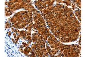 The image on the left is immunohistochemistry of paraffin-embedded Human liver cancer tissue using ABIN7190937(HIBADH Antibody) at dilution 1/25, on the right is treated with synthetic peptide. (HIBADH 抗体)