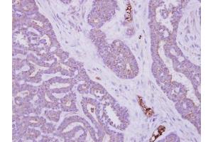 IHC-P Image Immunohistochemical analysis of paraffin-embedded human colon carcinoma, using MTMR14, antibody at 1:500 dilution. (MTMR14 抗体)