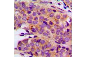 Immunohistochemical analysis of PRIM1 staining in human breast cancer formalin fixed paraffin embedded tissue section. (PRIM1 抗体  (C-Term))