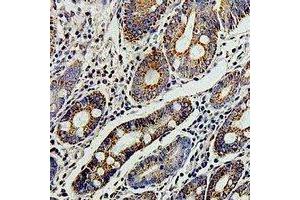 Immunohistochemical analysis of TERE1 staining in human colon cancer formalin fixed paraffin embedded tissue section. (UBIAD1 抗体)