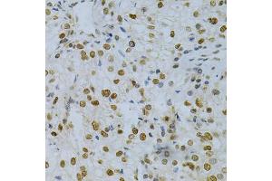 Immunohistochemistry of paraffin-embedded human kidney cancer using ELAVL1 Antibody (ABIN5970780) at dilution of 1/200 (40x lens). (ELAVL1 抗体)