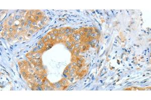 Immunohistochemistry of paraffin-embedded Human cervical cancer using ASNS Polyclonal Antibody at dilution of 1:60 (Asparagine Synthetase 抗体)