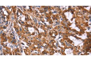 Immunohistochemistry of paraffin-embedded Human thyroid cancer tissue using HACE1 Polyclonal Antibody at dilution 1:40