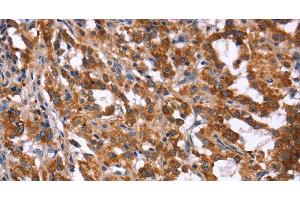 Immunohistochemistry of paraffin-embedded Human thyroid cancer tissue using HACE1 Polyclonal Antibody at dilution 1:40 (HACE1 抗体)