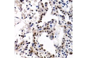Immunohistochemistry of paraffin-embedded human lung cancer using ID3 antibody (ABIN6130481, ABIN6142140, ABIN6142141 and ABIN6221020) at dilution of 1:200 (40x lens). (ID3 抗体  (AA 1-119))