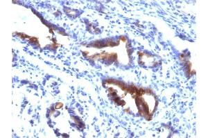 Formalin-fixed, paraffin-embedded human Gastric Carcinoma stained with MUC3 Mouse Monoclonal Antibody (M3. (MUC3A 抗体)