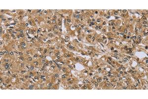 Immunohistochemistry of paraffin-embedded Human prostate cancer using TXLNA Polyclonal Antibody at dilution of 1:30 (alpha Taxilin 抗体)