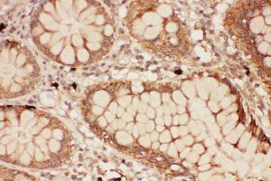 Anti-ALOX15 Picoband antibody,  IHC(P): Human Intestine Cancer Tissue (ALOX15 抗体  (AA 2-337))