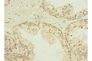 Immunohistochemistry of paraffin-embedded human prostate cancer using ABIN7170943 at dilution of 1:100 (Sulfide:quinone Oxidoreductase, Mitochondrial (SQOR) (AA 211-450) 抗体)