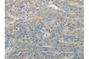 The image on the left is immunohistochemistry of paraffin-embedded Human ovarian cancer tissue using ABIN7131158(SPATA17 Antibody) at dilution 1/15, on the right is treated with fusion protein. (SPATA17 抗体)