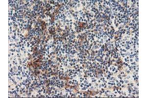 Immunohistochemical staining of paraffin-embedded Human lymphoma tissue using anti-NAPEPLD mouse monoclonal antibody. (NAPEPLD 抗体)