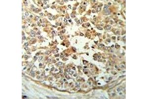 STING antibody IHC analysis in formalin fixed and paraffin embedded breast carcinoma. (STING/TMEM173 抗体  (AA 311-340))