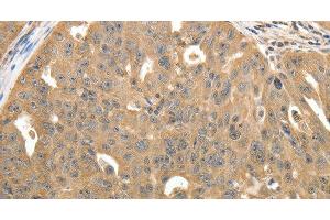 Immunohistochemistry of paraffin-embedded Human ovarian cancer using STX1A Polyclonal Antibody at dilution of 1:40 (STX1A 抗体)