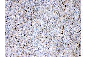 Synapsin I was detected in paraffin-embedded sections of human glioma tissues using rabbit anti- Synapsin I Antigen Affinity purified polyclonal antibody (Catalog # ) at 1 ? (SYN1 抗体  (C-Term))