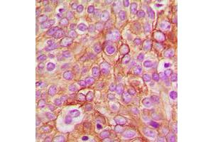 Immunohistochemical analysis of GABRB1 (pS434) staining in human breast cancer formalin fixed paraffin embedded tissue section. (GABRB1 抗体  (C-Term, pSer434))