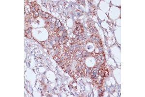 Immunohistochemistry of paraffin-embedded human colon carcinoma using MRPL23 antibody (ABIN7268564) at dilution of 1:100 (40x lens). (MRPL23 抗体  (AA 1-153))