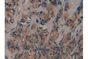 DAB staining on IHC-P; Samples: Human Breast cancer Tissue (Fibrillin 2 抗体  (AA 1550-1791))