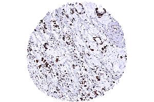 Gastric adenocarcinoma diffuse type with intense nuclear TRIM28 immunostaining of tumor cells (Recombinant KAP1 抗体  (Center))