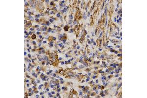 Immunohistochemistry of paraffin-embedded human lung cancer using MMP25 antibody (ABIN5971552) at dilution of 1/200 (40x lens). (MMP25 抗体)
