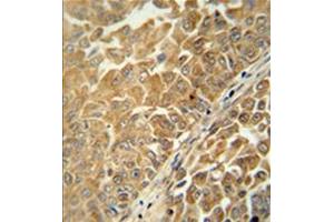 Formalin fixed, paraffin embedded human bladder carcinoma stained with C18orf25 Antibody  followed by peroxidase conjugation of the secondary antibody and DAB staining. (C18ORF25 抗体  (Middle Region))