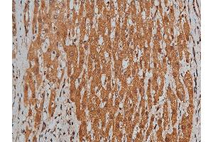 ABIN6260282 and ABIN6268699 at 1/200 staining human liver cancer tissue sections by IHC-P.