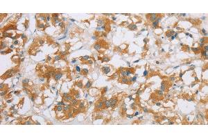 Immunohistochemistry of paraffin-embedded Human thyroid cancer using CYP2E1 Polyclonal Antibody at dilution of 1:35 (CYP2E1 抗体)