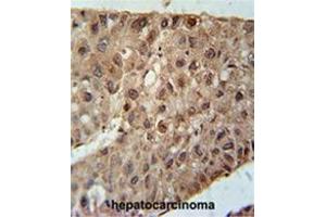 ZC4H2 Antibody (C-term) immunohistochemistry analysis in formalin fixed and paraffin embedded human hepatocarcinoma followed by peroxidase conjugation of the secondary antibody and DAB staining. (ZC4H2 抗体  (C-Term))