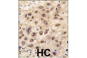 Formalin-fixed and paraffin-embedded human hepatocarcinoma tissue reacted with GNL3 antibody (C-term), which was peroxidase-conjugated to the secondary antibody, followed by DAB staining. (Nucleostemin 抗体  (C-Term))