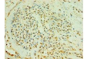 Immunohistochemistry of paraffin-embedded human breast cancer using ABIN7174009 at dilution of 1:100 (BLK 抗体  (AA 1-280))