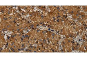 Immunohistochemistry of paraffin-embedded Human liver cancer tissue using MAS1 Polyclonal Antibody at dilution 1:50 (MAS1 抗体)