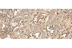 Immunohistochemistry of paraffin-embedded Human cervical cancer tissue using FSTL5 Polyclonal Antibody at dilution of 1:50(x200) (FSTL5 抗体)