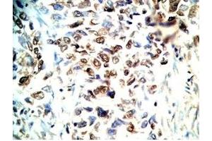 Human lung cancer tissue stained by Rabbit Anti-CRAMP(140-173) (Mouse) Antibody (Cathelicidin 抗体  (AA 140-173))