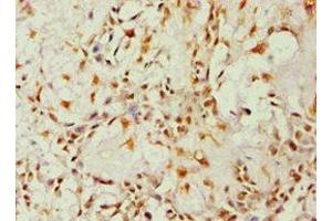 Immunohistochemistry of paraffin-embedded human breast cancer using ABIN7143676 at dilution of 1:100 (ALDH1B1 抗体  (AA 278-517))