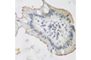 Immunohistochemistry of paraffin-embedded human stomach cancer using ALOX15 antibody (ABIN5975430) at dilution of 1/200 (40x lens). (ALOX15 抗体)