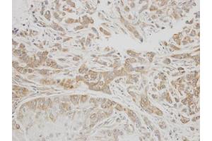 IHC-P Image Immunohistochemical analysis of paraffin-embedded A549 xenograft, using C1 inhibitor, antibody at 1:300 dilution. (SERPING1 抗体  (Center))