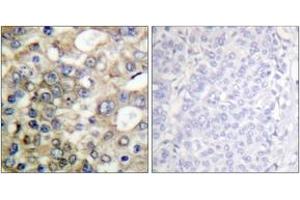 Immunohistochemistry analysis of paraffin-embedded human breast carcinoma tissue, using BTK (Ab-222) Antibody.