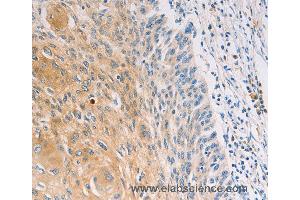 Immunohistochemistry of Human breast cancer using MUC5B Polyclonal Antibody at dilution of 1:30 (MUC5B 抗体)