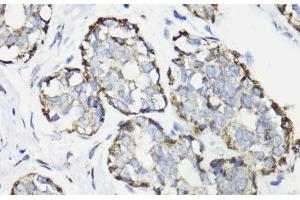 Immunohistochemistry of paraffin-embedded Human breast cancer using WASF3 Polyclonal Antibody at dilution of 1:100 (40x lens). (WASF3 抗体)