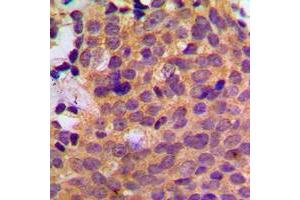 Immunohistochemical analysis of CK1 alpha staining in human breast cancer formalin fixed paraffin embedded tissue section. (CSNK1A1 抗体  (Center))