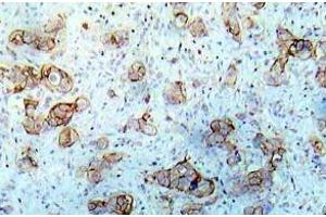 Immunohistochemistry (IHC) analyzes of EGFR pAb in paraffin-embedded human breast carcinoma tissue. (EGFR 抗体)