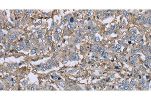 Immunohistochemistry of paraffin-embedded Human liver cancer using CD32 Polyclonal Antibody at dilution of 1:40 (Fc gamma RII (CD32) 抗体)