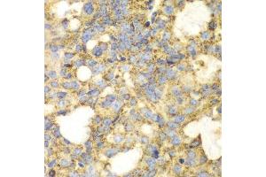 Immunohistochemistry of paraffin-embedded human oophoroma using SOD2 antibody. (SOD2 抗体  (AA 25-222))