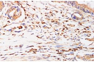 Immunohistochemistry of paraffin-embedded Human Duodenum cancer using IFNAR1 Polyclonl Antibody at dilution of 1:200. (IFNAR1 抗体)