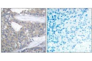 Immunohistochemical analysis of paraffin-embedded human breast carcinoma tissue using Paxillin (Ab-31) antibody (E021199). (Paxillin 抗体)