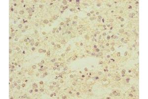 Immunohistochemistry of paraffin-embedded human glioma using ABIN7143097 at dilution of 1:100 (ARPC5 抗体  (AA 1-154))