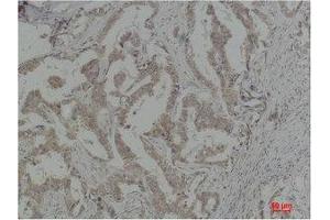 Immunohistochemistry (IHC) analysis of paraffin-embedded Human Breast Carcinoma using Caspase-8 Polyclonal Antibody. (Caspase 8 抗体)